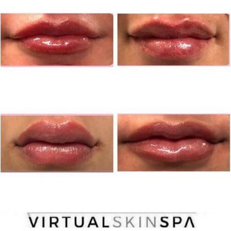 juvederm long island juvederm long island