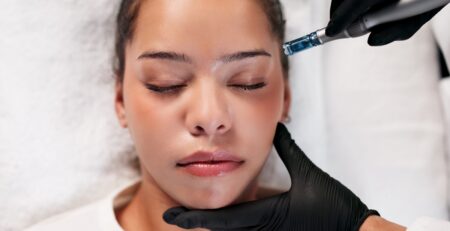 microneedling cost long island